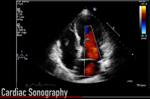 image of a cardiac ultrasound with color overlay