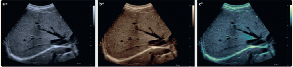 Ultrasound image of the liver in three different gray scale and color scale options