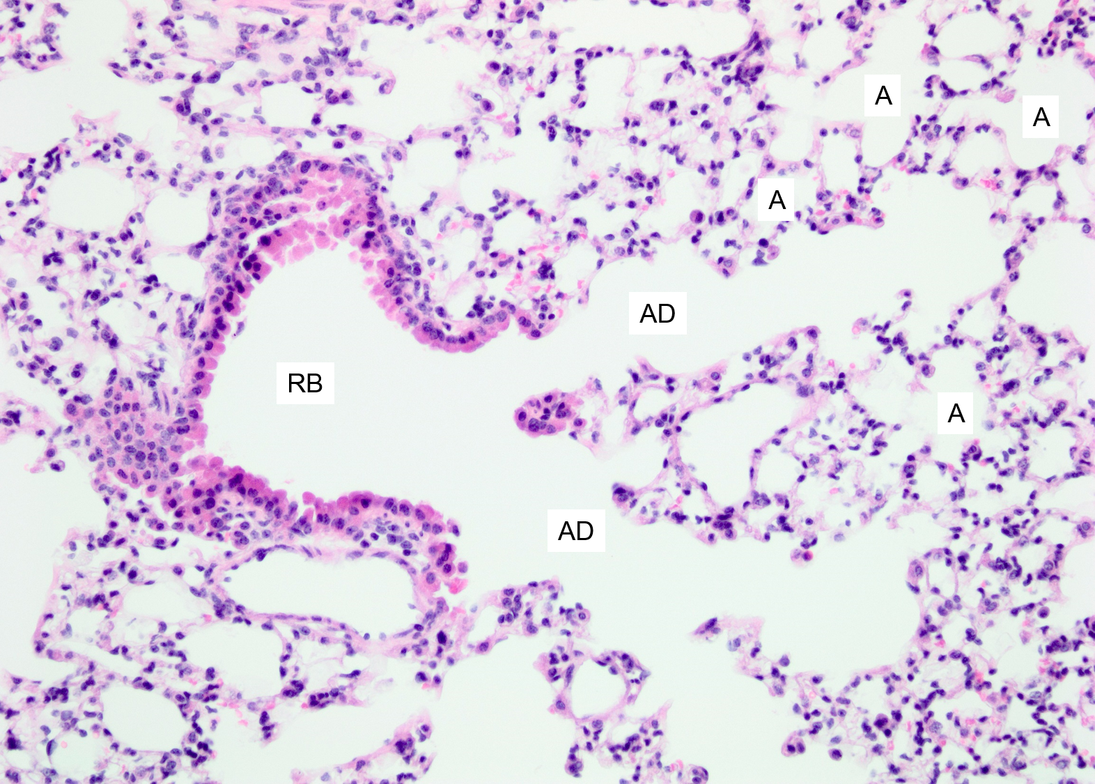 interstitial lung disease histology