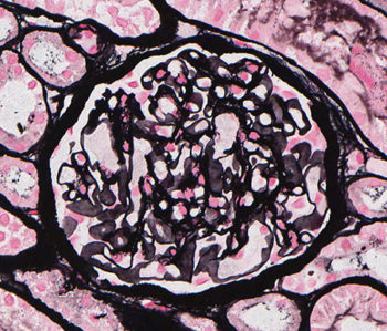 Amyloidosis – Atlas of Renal Lesions in Proteinuric Dogs