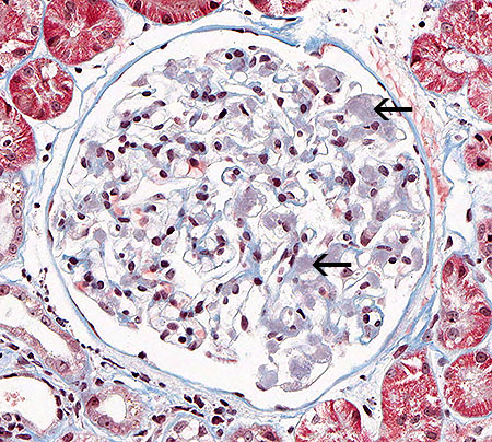 Amyloidosis – Atlas of Renal Lesions in Proteinuric Dogs