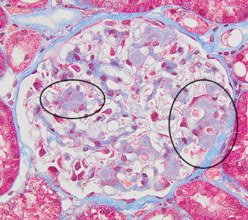 Amyloidosis – Atlas of Renal Lesions in Proteinuric Dogs