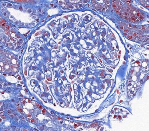 Membranous Glomerulonephropathy – Atlas of Renal Lesions in Proteinuric ...