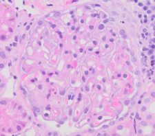 Membranous Glomerulonephropathy – Atlas of Renal Lesions in Proteinuric ...