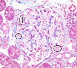 Membranous Glomerulonephropathy – Atlas of Renal Lesions in Proteinuric ...