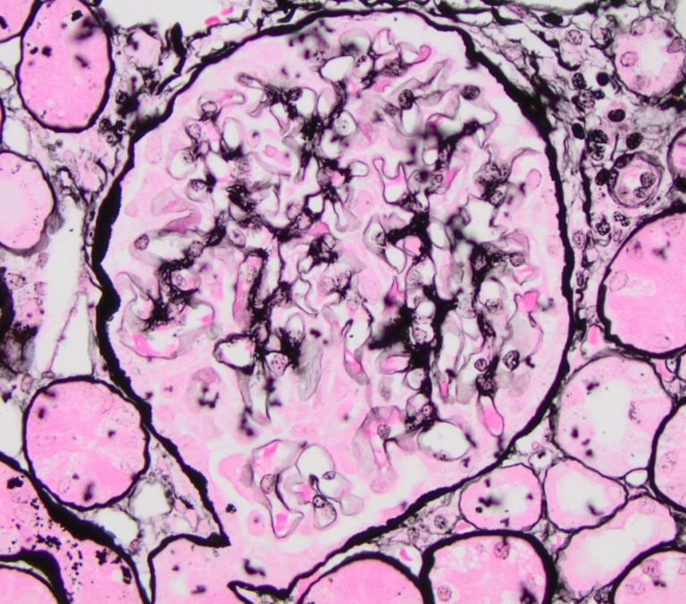 Membranous Glomerulonephropathy – Atlas of Renal Lesions in Proteinuric ...