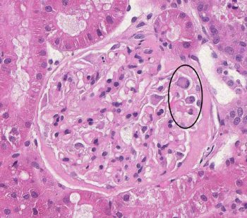 Membranous Glomerulonephropathy – Atlas of Renal Lesions in Proteinuric ...