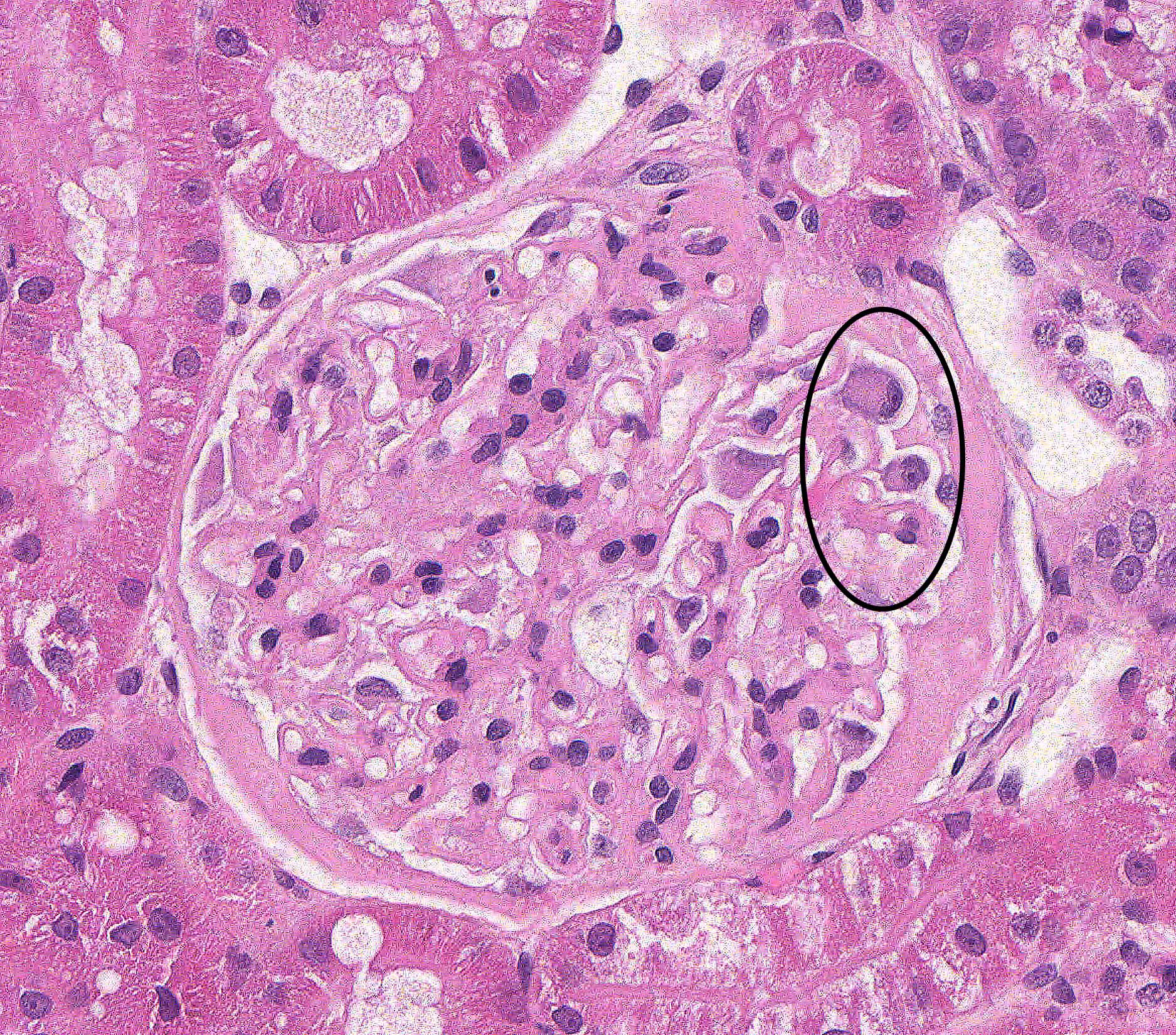 Membranous Glomerulonephropathy Atlas Of Renal Lesions In Proteinuric