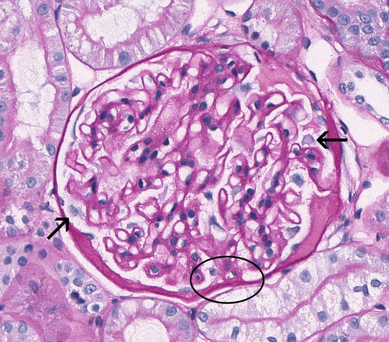 Membranous Glomerulonephropathy – Atlas of Renal Lesions in Proteinuric ...