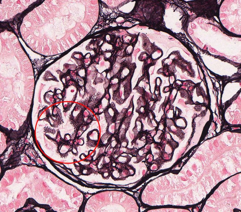 Membranous Glomerulonephropathy – Atlas of Renal Lesions in Proteinuric ...