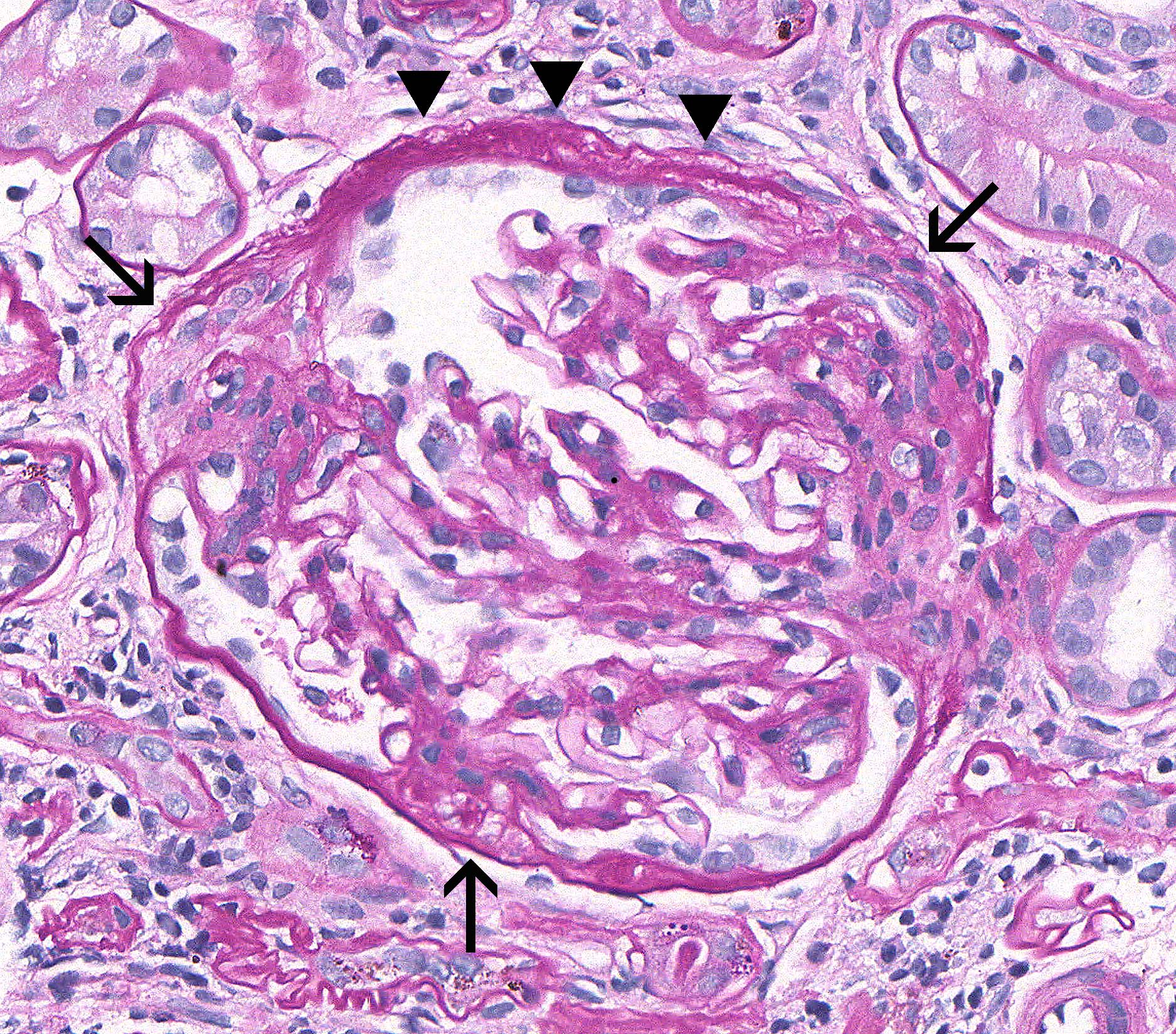 Focal Segmental Glomerulosclerosis – Atlas Of Renal Lesions In ...