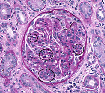 Membranoproliferative Glomerulonephritis – Atlas of Renal Lesions in ...