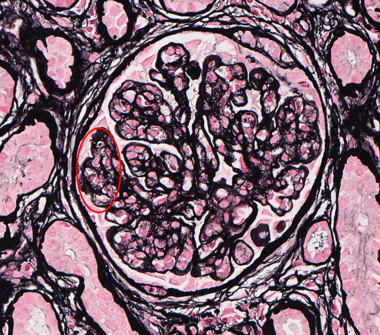 Membranoproliferative Glomerulonephritis – Atlas of Renal Lesions in ...