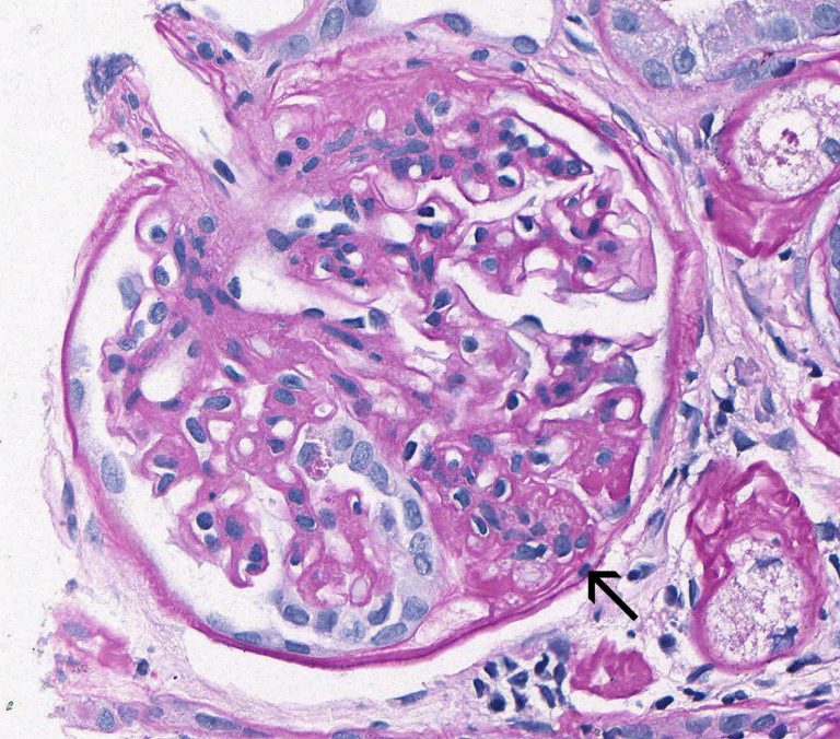 Focal Segmental Glomerulosclerosis – Atlas of Renal Lesions in ...