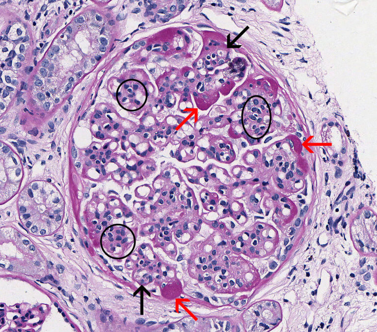 Membranoproliferative Glomerulonephritis – Atlas Of Renal Lesions In 