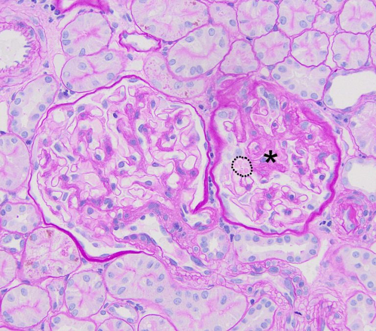 Focal Segmental Glomerulosclerosis – Atlas of Renal Lesions in ...