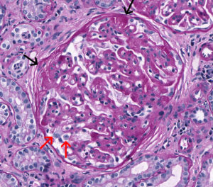 Membranoproliferative Glomerulonephritis – Atlas of Renal Lesions in ...