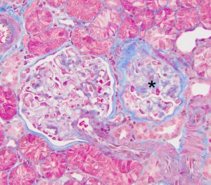 Focal Segmental Glomerulosclerosis – Atlas of Renal Lesions in ...