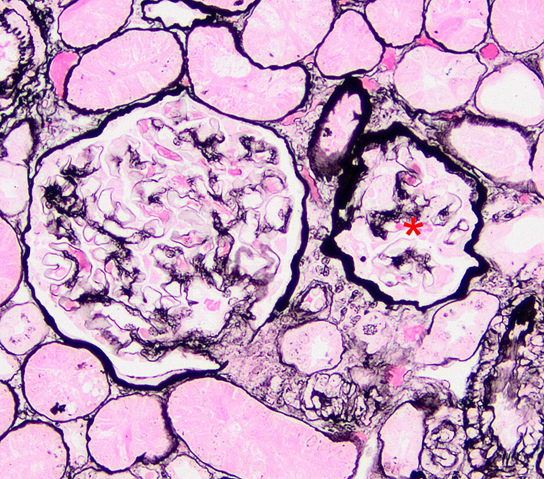 Focal Segmental Glomerulosclerosis – Atlas Of Renal Lesions In ...