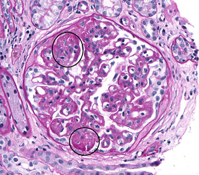 Membranoproliferative Glomerulonephritis – Atlas of Renal Lesions in ...