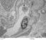 Focal Segmental Glomerulosclerosis – Atlas of Renal Lesions in ...