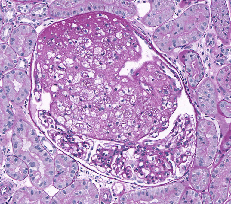 Miscellaneous Glomerular Diseases – Atlas of Renal Lesions in ...