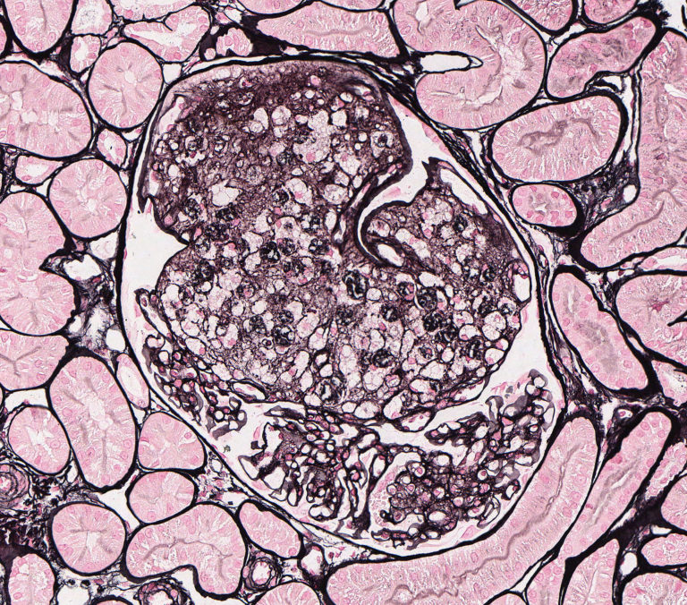 Miscellaneous Glomerular Diseases – Atlas of Renal Lesions in ...