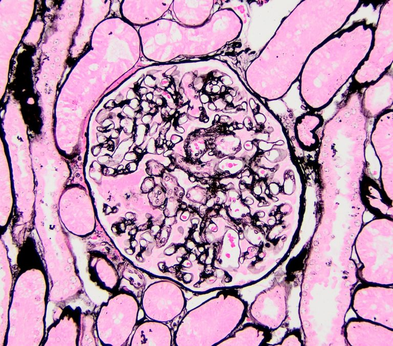 Miscellaneous Glomerular Diseases – Atlas of Renal Lesions in ...