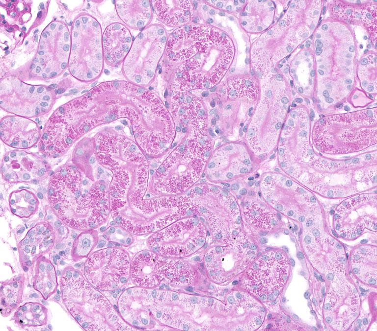 Tubular, Interstitial and Vascular Pathology seen with Glomerular ...