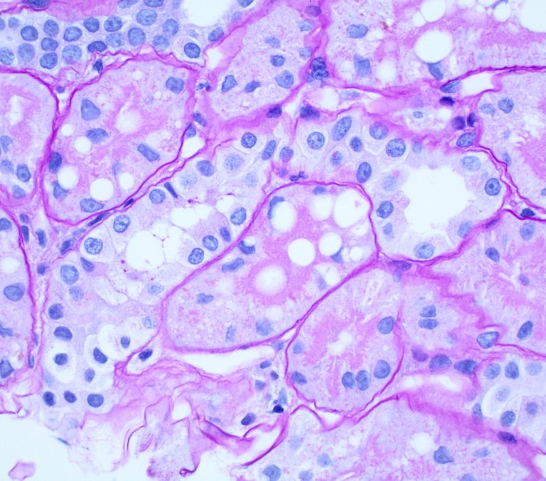 Tubular, Interstitial And Vascular Pathology Seen With Glomerular 