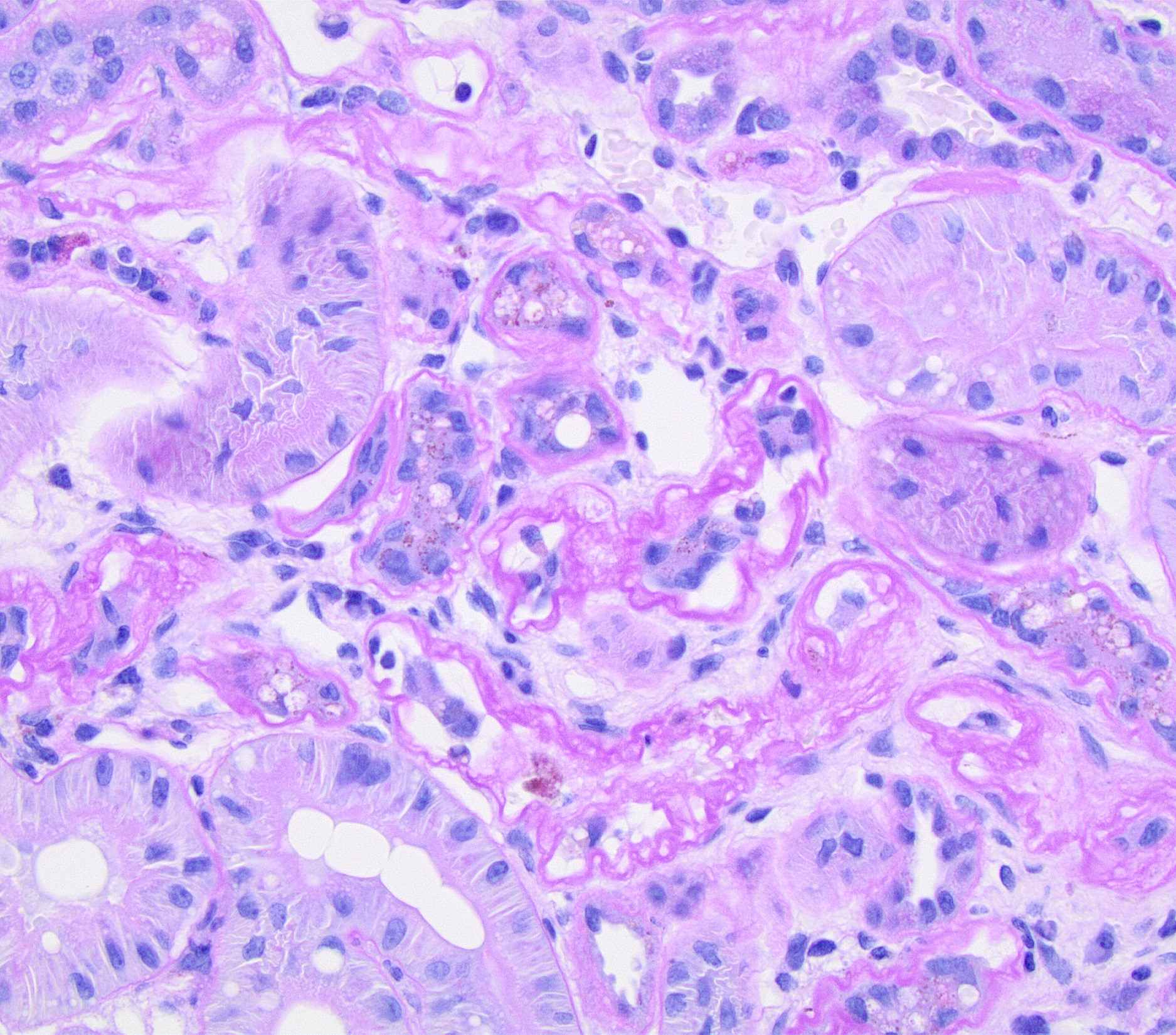 Tubular, Interstitial And Vascular Pathology Seen With Glomerular 