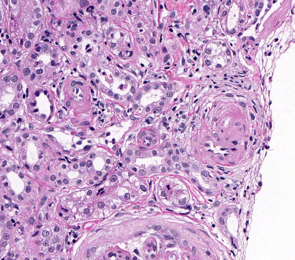 Tubular, Interstitial and Vascular Pathology seen with Glomerular ...