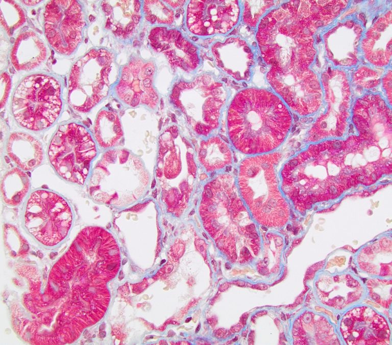 Tubular, Interstitial and Vascular Pathology seen with Glomerular ...