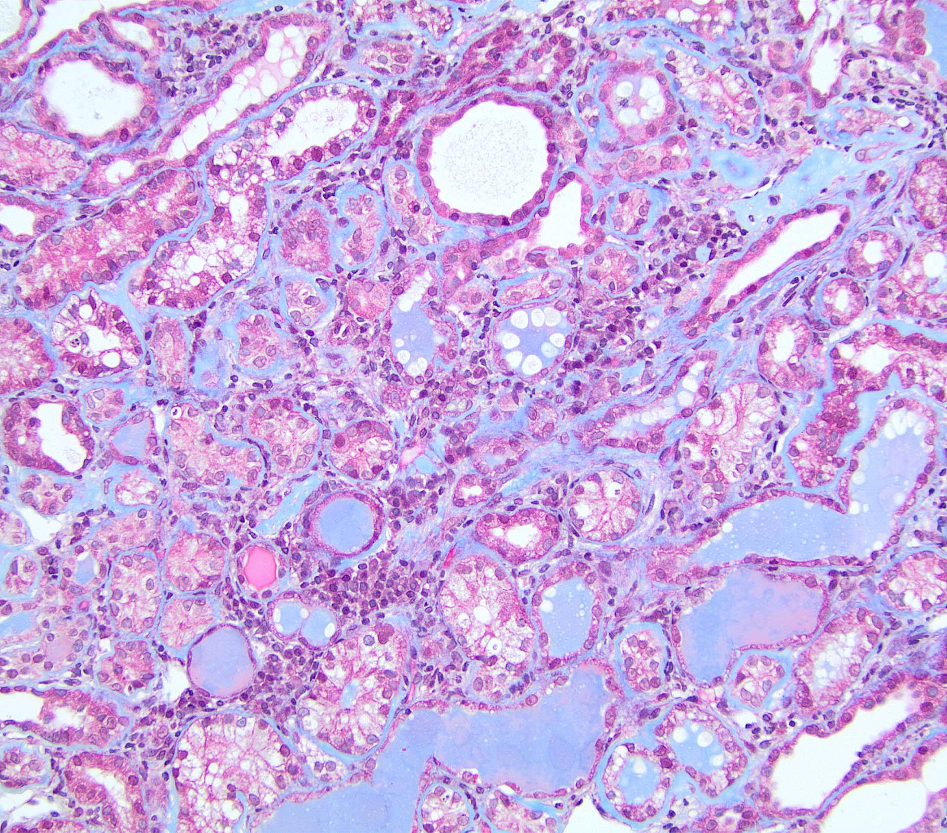 Tubular, Interstitial and Vascular Pathology seen with Glomerular ...