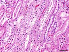 Tubular, Interstitial and Vascular Pathology seen with Glomerular ...