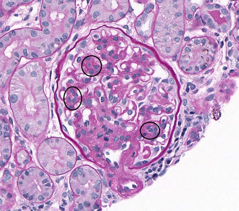 Miscellaneous Glomerular Diseases – Atlas of Renal Lesions in ...