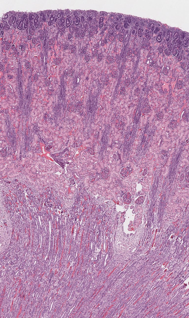 Juvenile Onset Chronic Kidney Disease (juvenile Nephropathy) – Atlas Of 